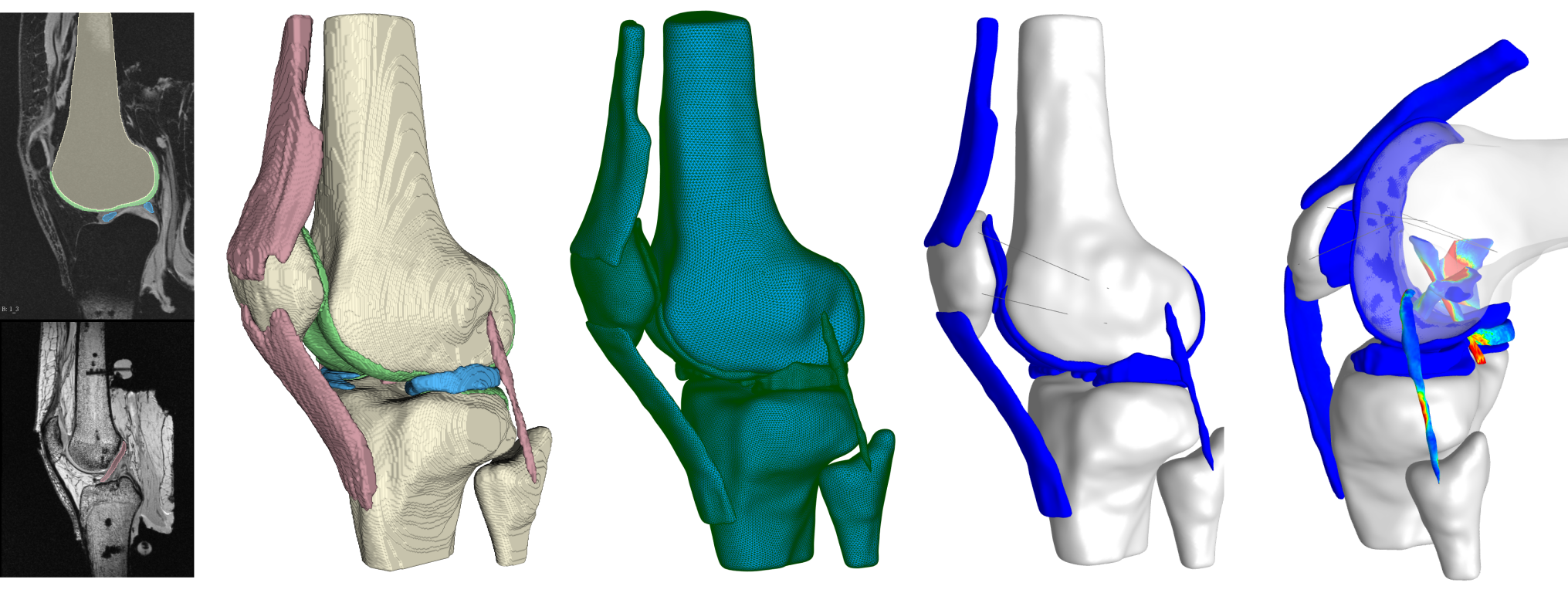 Open Knee(s) - Generation 2