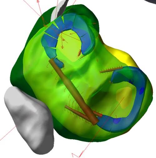 picture of Discrete body menisci